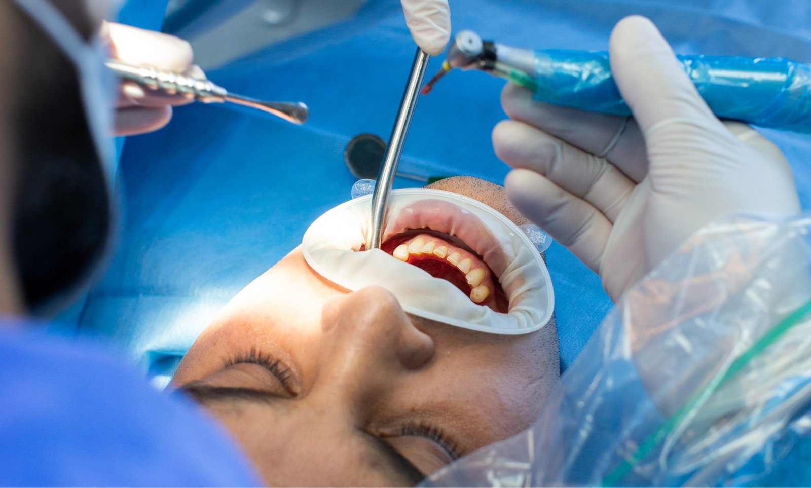 tratamiento-cirugia-mp-ellite-dental-1620x975
